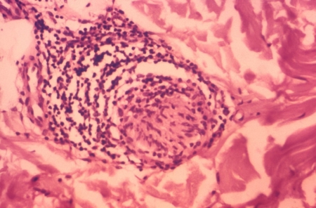 Hansen’s Disease (Leprosy; Mycobacterium leprae) 