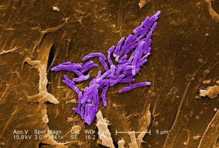 Non-tuberculous Mycobacteria infection (extra-pulmonary)