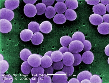 Staphylococcus Enterotoxin B (SEB) Pulmonary Poisoning