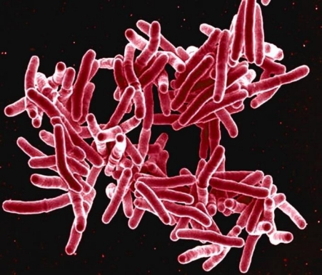 Tuberculosis (Disease)