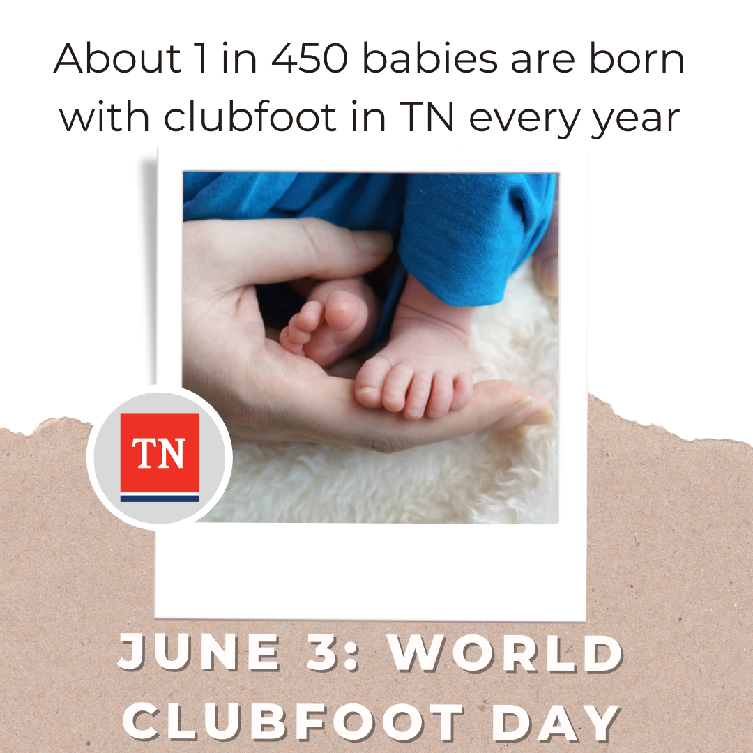 1 in 450 babies are born with club foot in TN every year