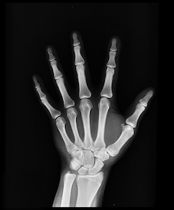 National Osteoporosis Month Xray of a hand